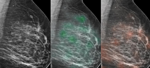 该AI工具有助于以90%的准确率识别乳腺癌