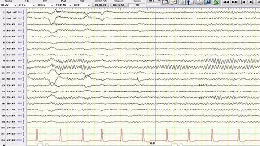 研究人员在睡眠实验室的两个不同夜晚获得了17名健康人的脑电图记录