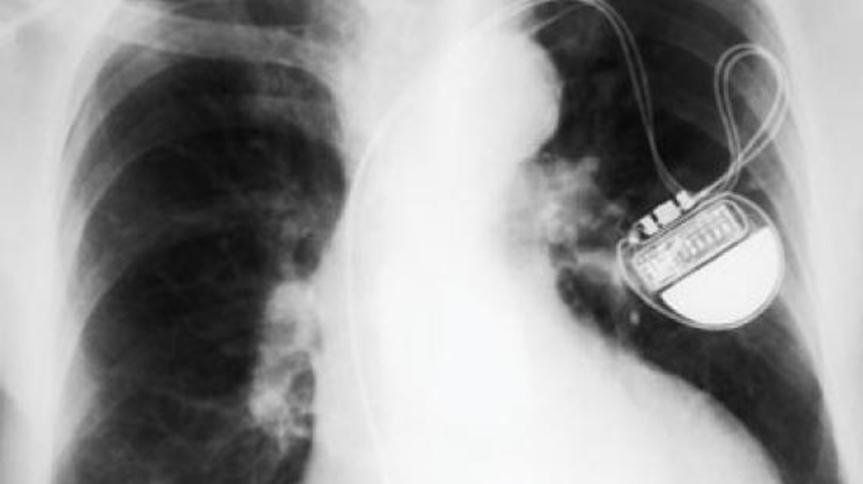 AI使用X射线以99.6％的精度识别心律失常设备制造商