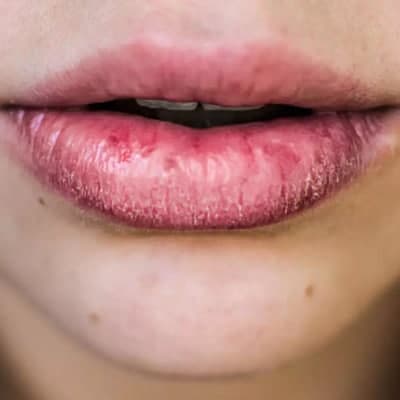 嘴唇越舔越容易干裂是因为什么？