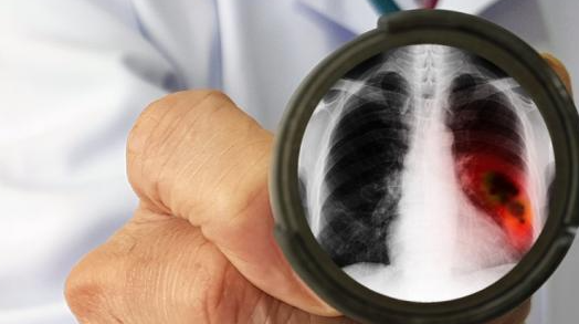 FDA已批准使用AI来检测肺部
